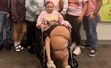 Teen Recovers After 17-Hour Marathon Surgery to Remove 174-Pound Leg