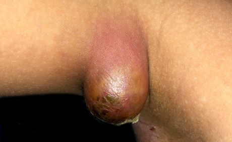 3 reasons you get armpit boils and natural fixes