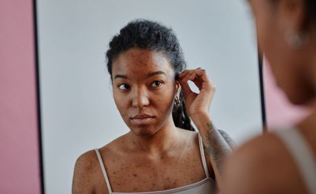 Stress acne is ruining your skin and skincare can’t fix it