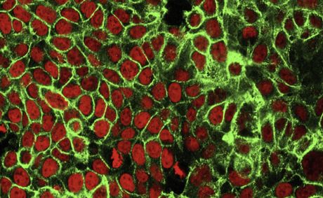 Study Finds Colon Cancer Deaths In The US On The Rise