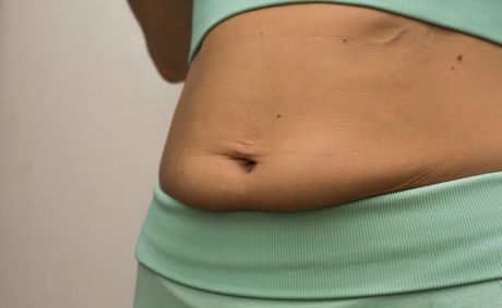 What really causes stubborn lower belly pouch in women