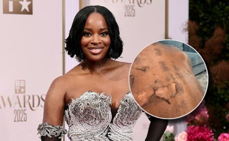 Graphic Photos Of Shamea Morton’s Chemical Peel Injuries Surface As Lawsuit Gets Messy