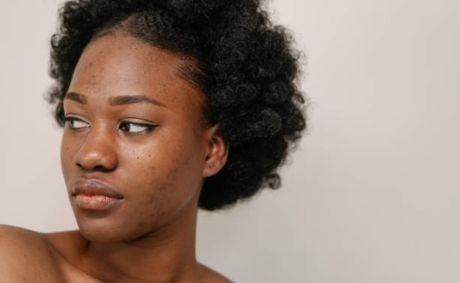 Thinking About Spironolactone For Acne? What Black Women Need To Know First