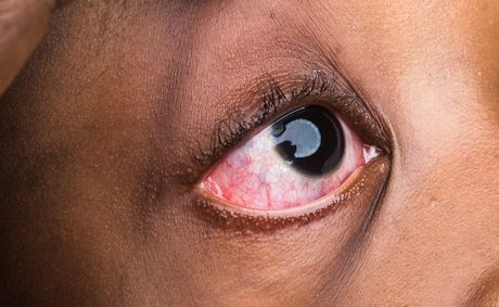 What red veins in your eyes reveal about your health