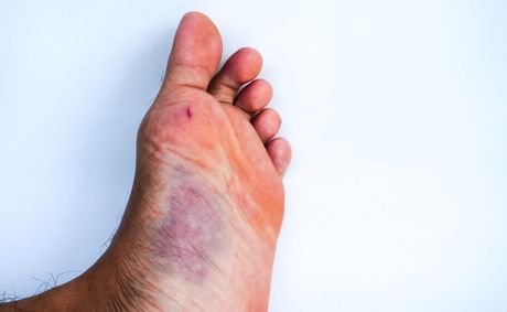 How your feet reveals diabetes years before diagnosis