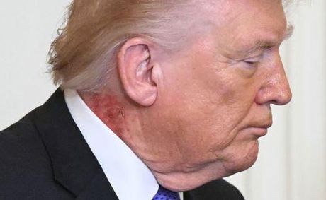White House Doctor Explains President Trump's Neck Rash