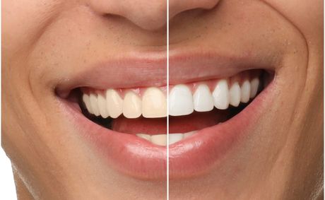 Whitening toothpaste daily? Read this first