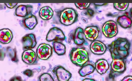 2 people have died from the measles in Pennsylvania