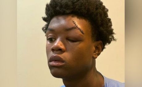 Black Teen Knocked Unconscious in Alleged Attack at a Mental Health Facility