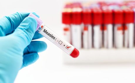 Measles outbreaks grow in three states as cases hit 2,700