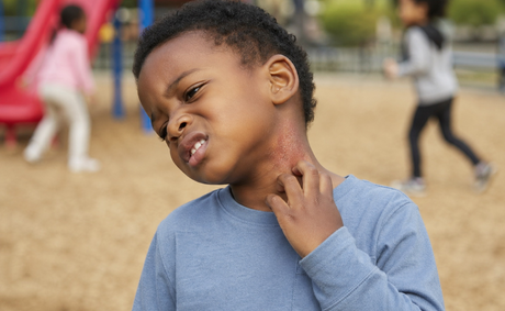 How Atopic Dermatitis Impacts Black Children