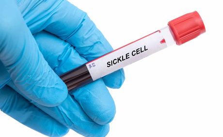 Sickle cell trait: the vital screening most parents miss