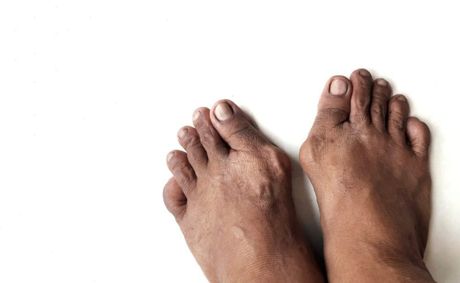 6 ways to correct a bunion when your big toe is bending
