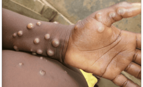 Mpox Cases Rise to 22 in South Africa as Imported Infections Confirmed