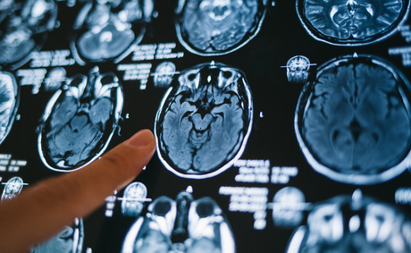 Why Black Americans face a deadlier brain aneurysm threat