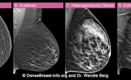 JoAnn Pushkin and Dr. Wendie Berg explain dense breasts and how they can hide breast cancer