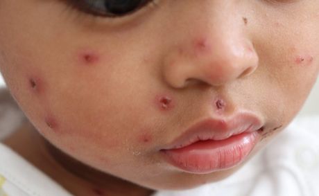 Pennsylvania measles outbreak passes South Carolina with 1004 cases