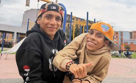 Conjoined Twin Brothers Sadly Pass Away At 27 After One of Them Suffered a Heart Attack