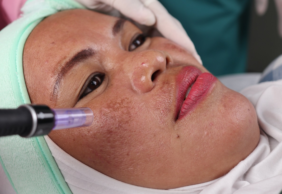 Hayyu Syar'i Kenalan Sama Flek Mirip Pulau Bernama Melasma Yuk! Apa Penyebabnya? Hayyu Syar'i Kenalan Sama Flek Mirip Pulau Bernama Melasma Yuk! Apa Penyebabnya?