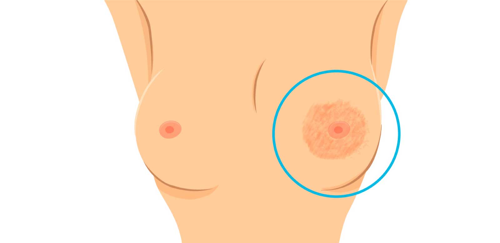 причины втянутого соска на груди у женщин фото 76