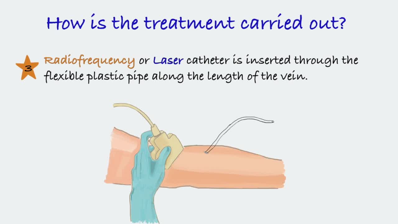 Endovenous ablation of saphenous vein 