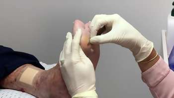 Removing foot callous from a diabetic foot site