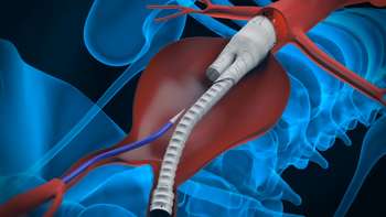 Anaconda Endovascular Aortic Stent Graft