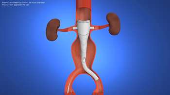 Fenestrated Anaconda Endovascular Aortic Stent Graft