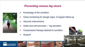 Dr Kathleen Finlayson: Avoiding Venous Leg Ulcers