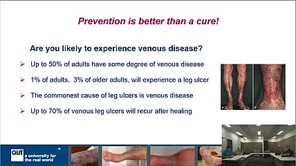 Dr Kathleen Finlayson: Avoiding Venous Leg Ulcers