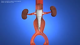 Fenestrated Anaconda Endovascular Aortic Stent Graft