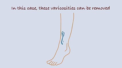 Overview of treatment options for varicose veins