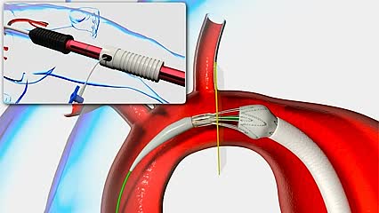 RelayPlus Endovascular Thoracic Stent