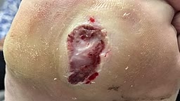 Removing foot callous from a diabetic foot site