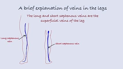 Sapheno-popliteal ligation surgery