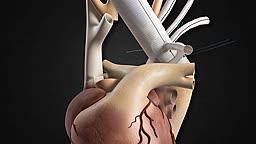 Thoraflex Hybrid Stent