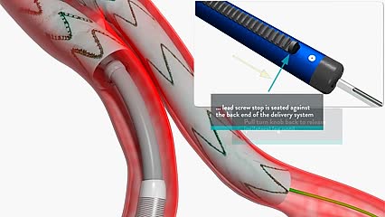 TREO Aortic Stent