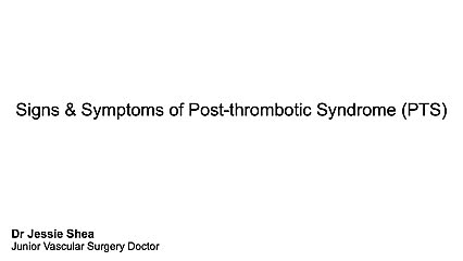 What are the main signs and symptoms of PTS?