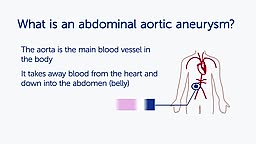 What is an Abdominal Aortic Aneurysm (AAA)