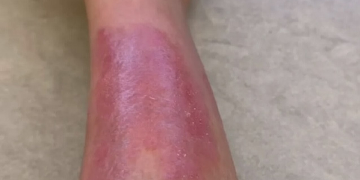 "Kim Kardashian Posts Videos on Instagram Showing Her 'Painful' Psoriasis Flare-Up"