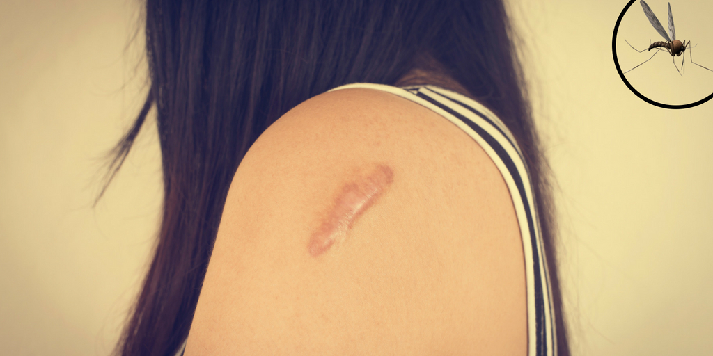 kala azar, treatment-symptoms-Kala Azar Caused Insect In Hindi