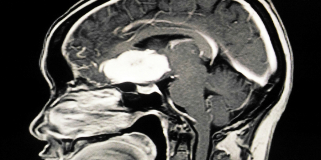 World Brain Tumor Day 2018, Buy Medicine Online, Online Pharmacy Noida, Online Medicines, Buy Medicine Online Noida, Nearby Pharmacy, Purchase Medicine Online, GoMedii