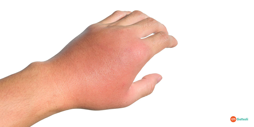 edema in hindi
