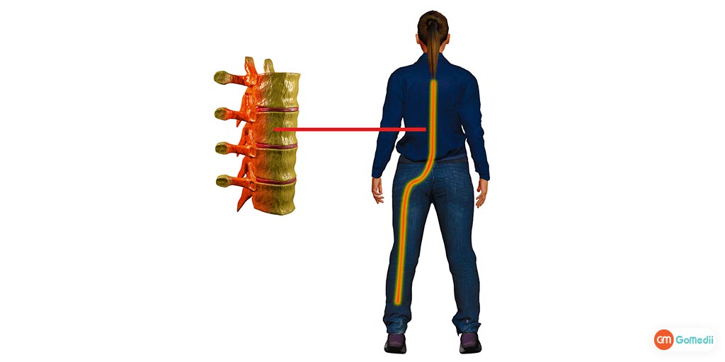 sciatica pain kyu hota hai in hindi