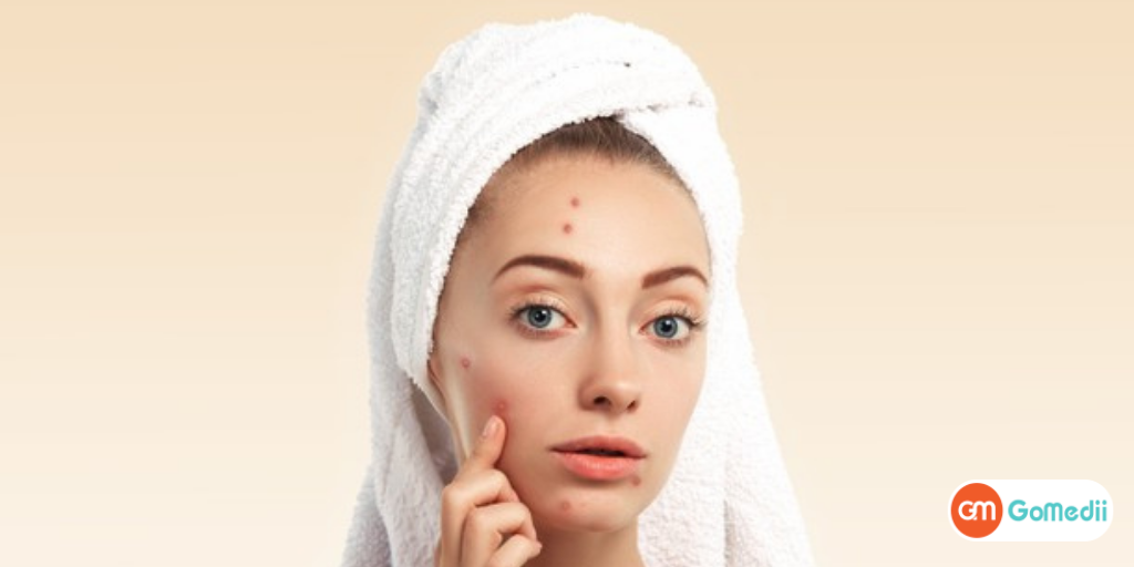 अपने चेहरे पर दाने (Pimple) हटाने के लिए क्या करें? - GoMedii