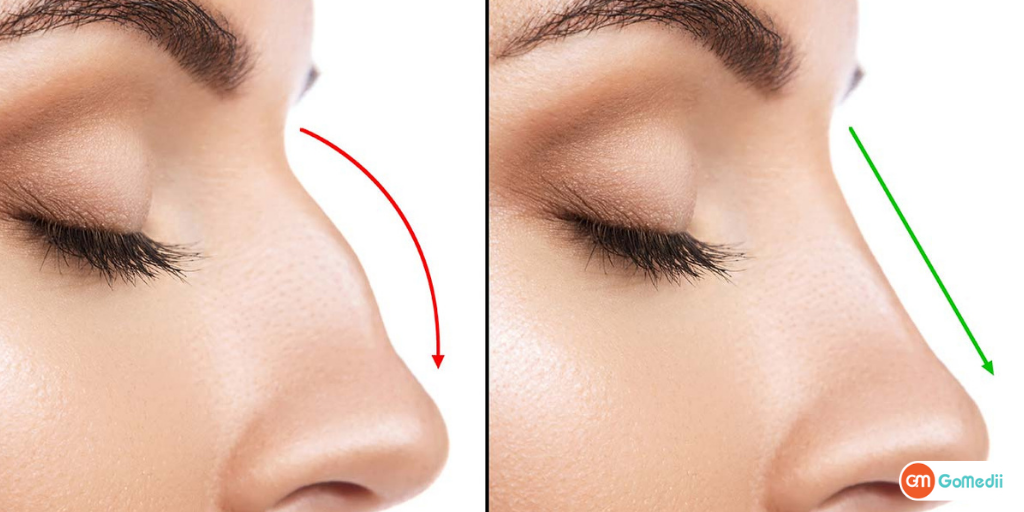 भारत में राइनोप्लास्टी सर्जरी का खर्च (Rhinoplasty surgery) कितना है?- GoMedii