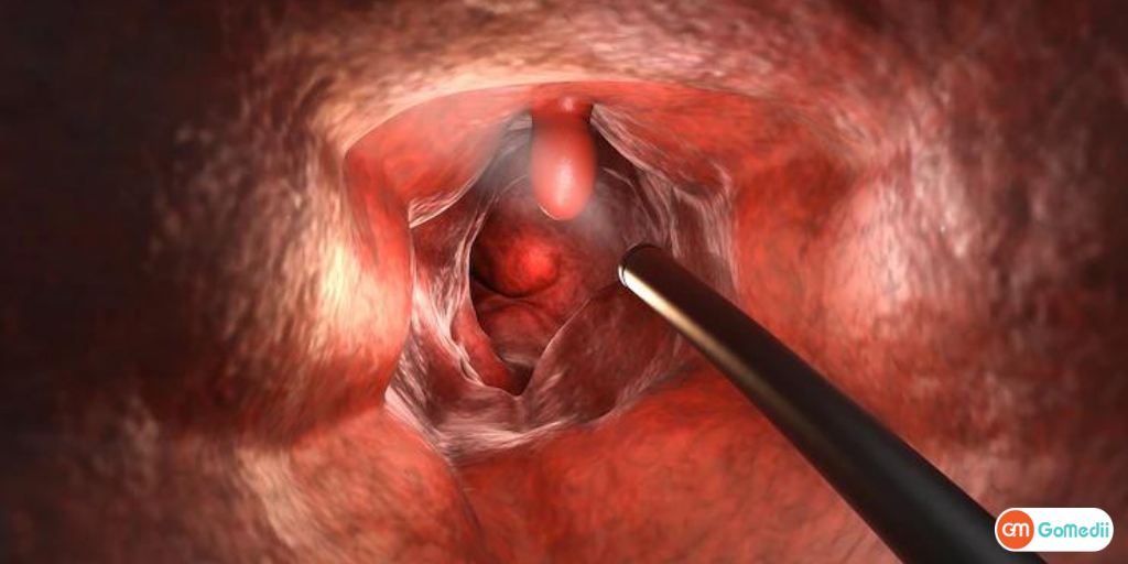 colonoscopy test in hindi