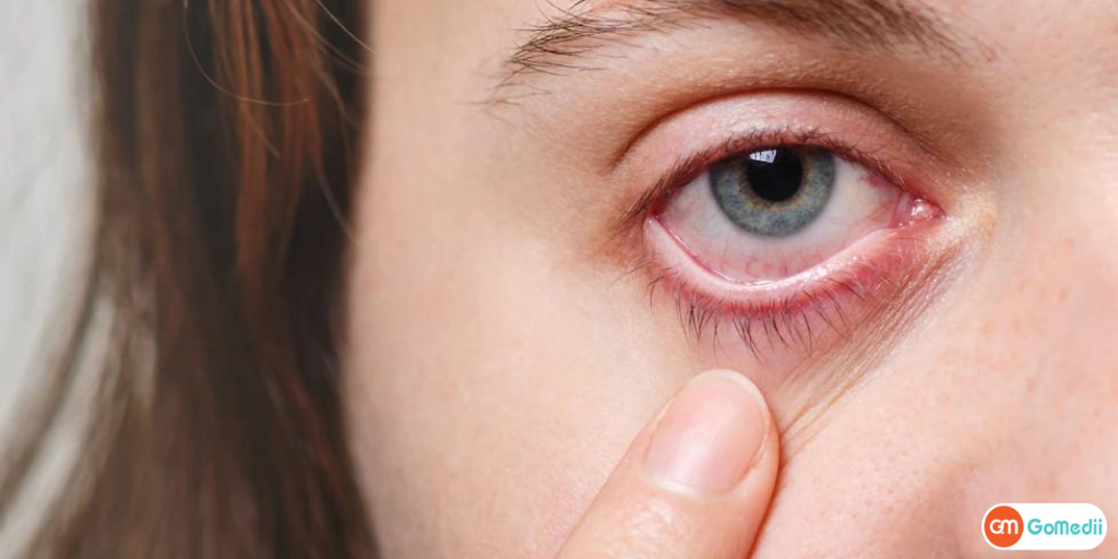 कंजंक्टिवाइटिस (Conjunctivitis) क्या है जाने इसका इलाज कहां कराएं ? - GoMedii