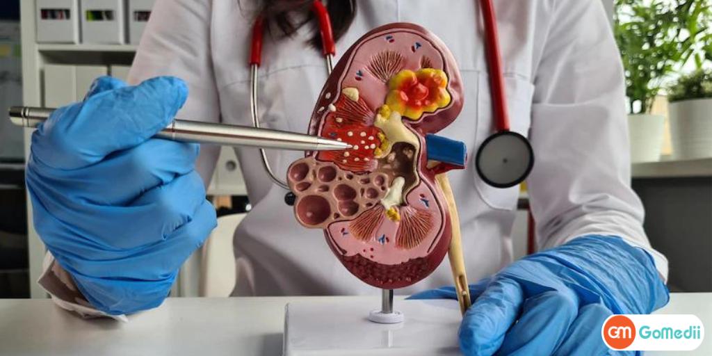 पॉलीसिस्टिक किडनी के इलाज का खर्च और जाने इसके लिए बेस्ट हॉस्पिटल - GoMedii