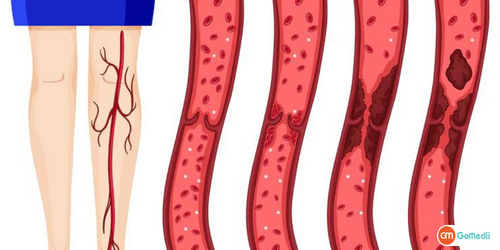 डीप वेन थ्रोम्बोसिस के लिए जोखिम कारक क्या हैं,What are the risk factors for deep vein thrombosis in hindi,